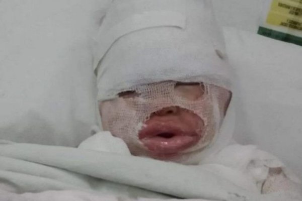 Evoluciona estable niña que se quemó el cuerpo luego de que le volcaran aceite hirviendo en un bar