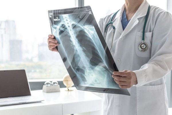 Aprobaron una nueva droga para un subtipo de cáncer de pulmón