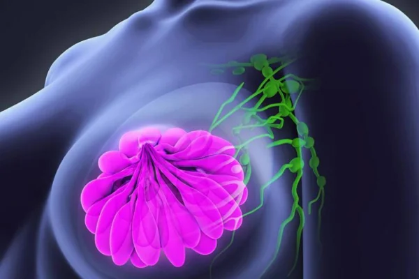 Cáncer de mama: estudio revela que terapias combinadas pueden ser más eficaces en el tratamiento