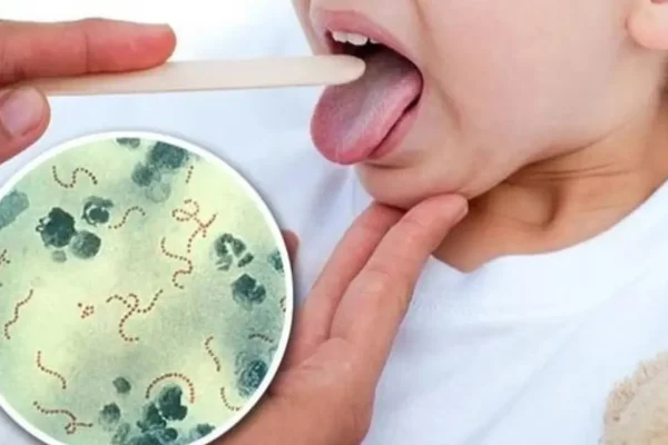 Streptococcus pyogenes: cuáles son los síntomas para hacer la consulta médica
