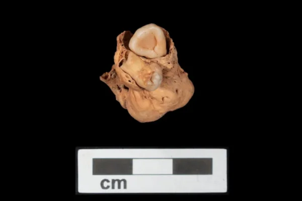 Histórico descubrimiento en Egipto: hallan un raro tumor de 3.000 años que podría cambiar el rumbo de la medicina