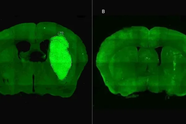 Especialistas del CONICET lograron frenar un tipo de cáncer cerebral con una novedosa estrategia terapéutica