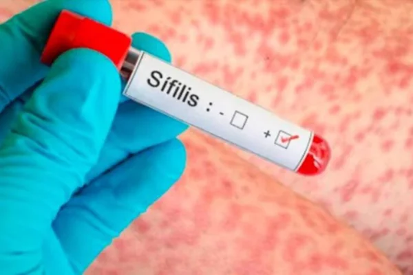 Alarma sanitaria en Córdoba y en todo el país por un récord de casos de sífilis