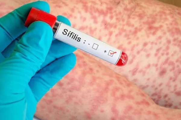 Sífilis: por qué crecen los contagios en Argentina y qué pasa en La Rioja