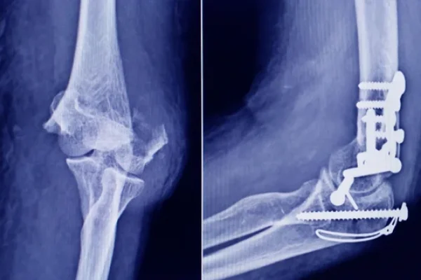 ANMAT advierte que un tornillo utilizado en cirugías traumatológicas es falso